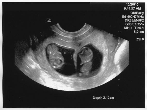 Twins Ultrasound